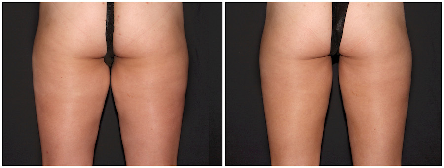 Striving for a Thigh Gap? How CoolSculpting Can Help - DaVinci Body  Sculpting