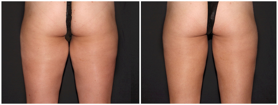 Striving for a Thigh Gap? How CoolSculpting Can Help - DaVinci